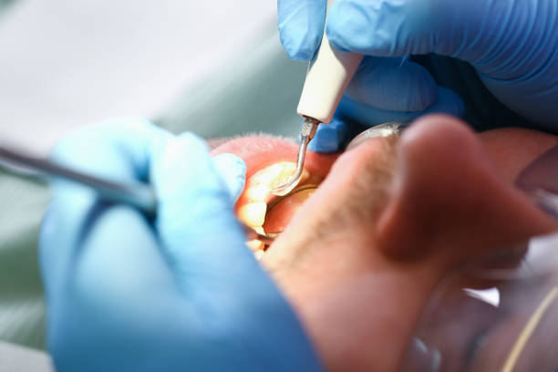 Best Emergency Dental Extractions in Desoto Lakes, FL